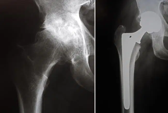 Do You Have Arthritic Hips Why You Need to Consider an Anterior Hip Replacement