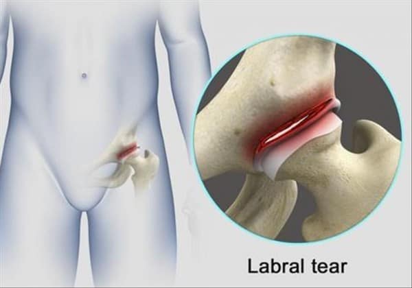 Labral Tear Hip Pain