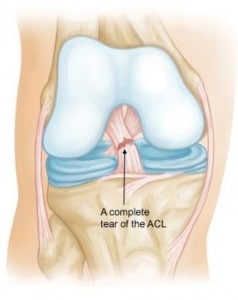 rupture-ACL