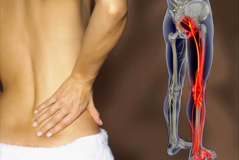 sciatica-pain-relief-treatment-remedies-and-exercises