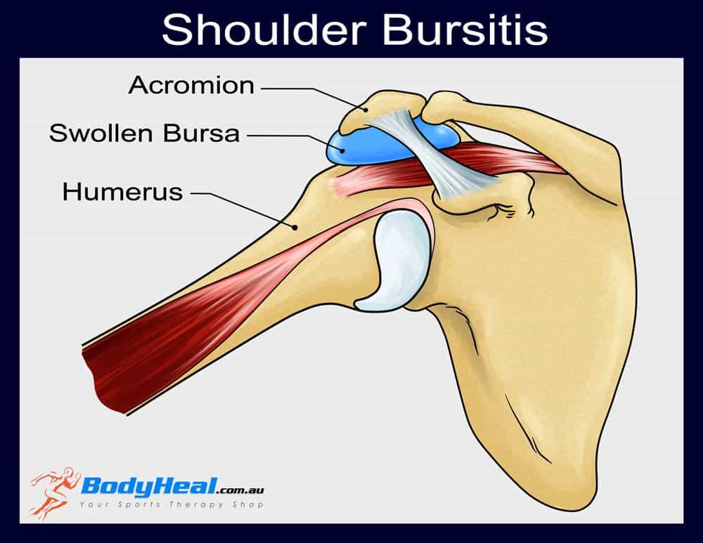 The sub-acromial bursa is a fluid filled sac that sits under the acromion bone and acts as a cushion between bones, tendons and muscles. It used to be thought that trauma would cause injury to the bursa, making it swell and causing a bursitis. Now it is known inflammation in the joint or muscle produces fluid which leaks into the bursa and causes distension.