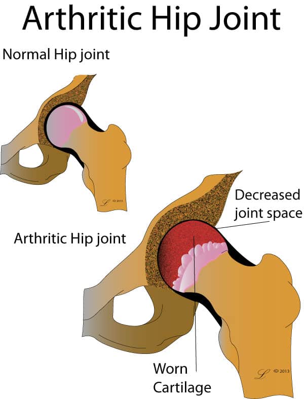 worn cartlidge hip pain