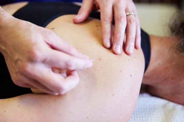 dry needle therapy in the clinic floreat